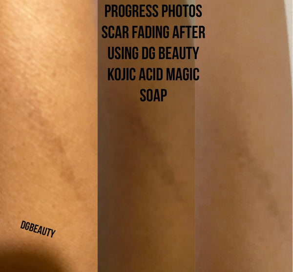 Best seller Kojic acid hyperpigmentation dark spot remover acne soap