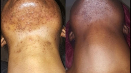 Best seller Kojic acid hyperpigmentation dark spot remover acne soap